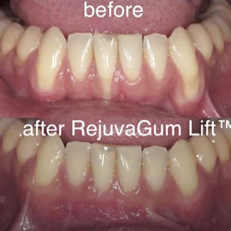 summerlin gum regeneration